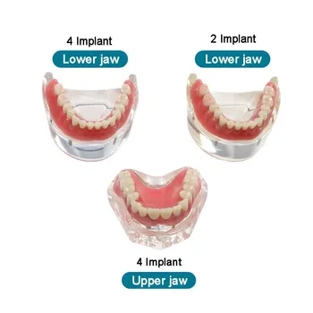 Модель зубов с имплантатом Overdenture Модель зубов с имплантатом Модель обучения стоматологии Трех типов